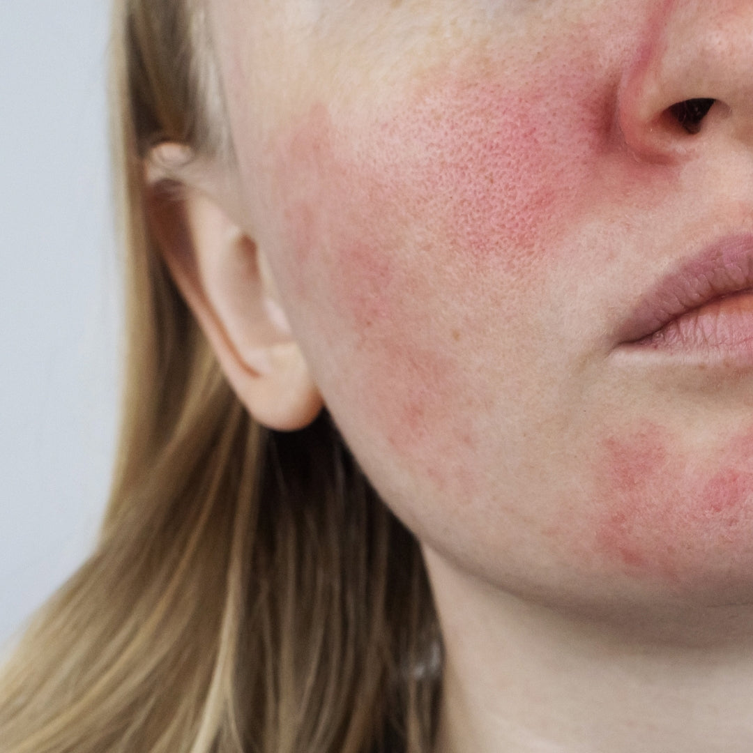 Navigating Facial Redness: A Gentle Expedition into Skincare Wisdom