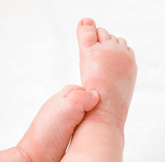 Dermatitis protection